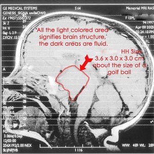 Hypothalamic Hamartoma MRI